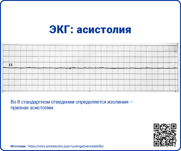 Экстрасистолия: как проявляется и как лечат?